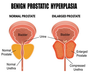 normal prostate vs enlarged prostate Benign Prostatic Hyperplasia